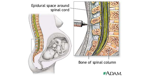 Anestesia Epidural Durante el Parto y Complicaciones en el Recién Nacido: ¿Es Oro Todo lo que Reluce?